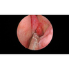 Sincope de 2.7 mm